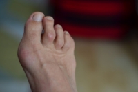 What Are Hammer or Claw Toes?