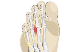 Treatment Options for Morton’s Neuroma
