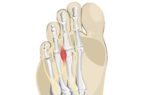 Treatment Options for Morton’s Neuroma