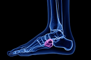 How Cuboid Syndrome Is Diagnosed