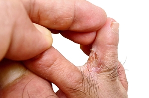 Differentiating Between Eczema and Athlete&#039;s Foot